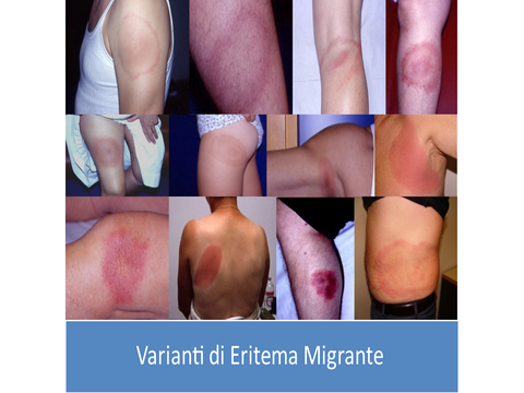 Lyme: come cambia l’eritema migrante